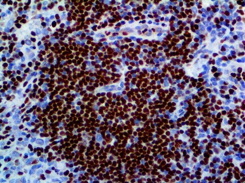 IHC of PU.1 on an FFPE Lymphoma Tissue